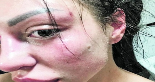 ŠOK ZA SVE MAJA MARINKOVIĆ PRETUČENA, SVA U PODLIVIMA, I TAKI SE UMEŠAO(FOTO)